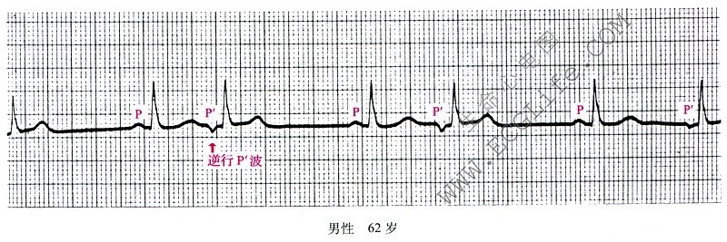 交界性期前收缩心电图