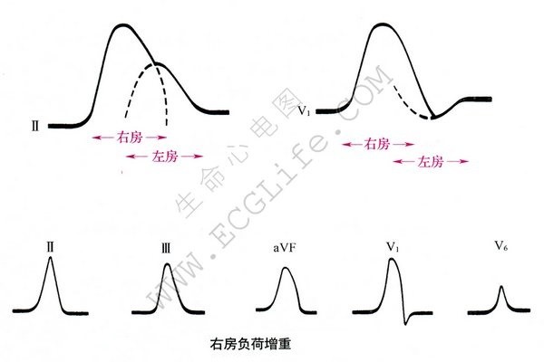 右房负荷增重心电图
