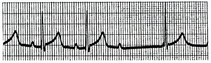 二度Ⅱ型房室传导阻滞心电图