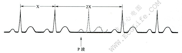 P波脱漏