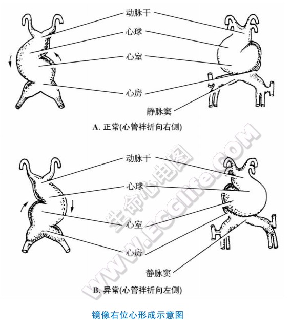 镜像右位心形成示意图