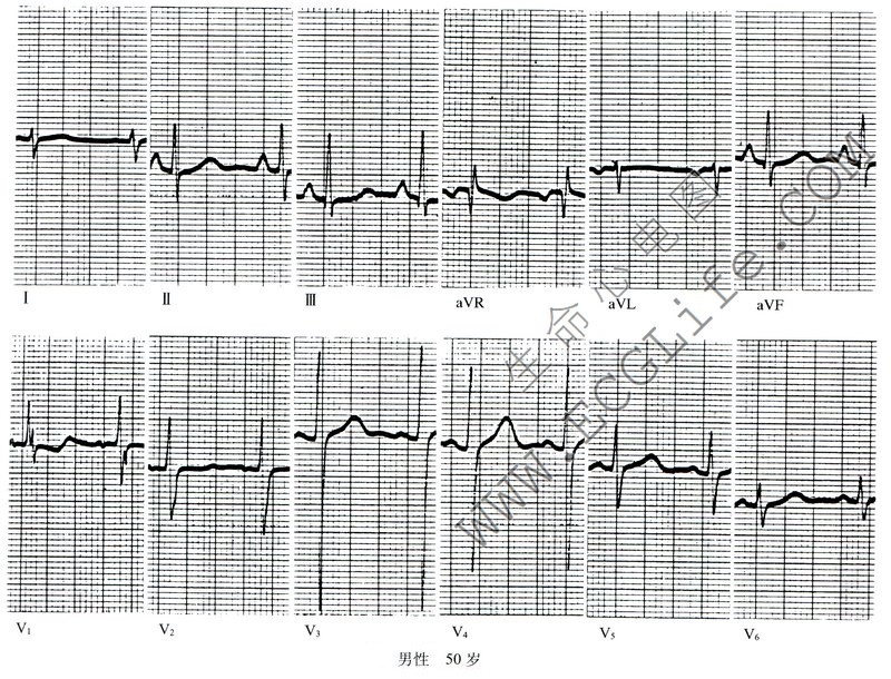 右室心电图图片