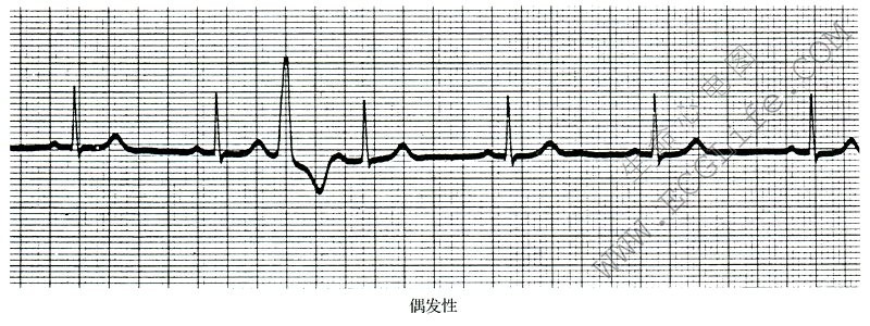 偶发性期前收缩心电图