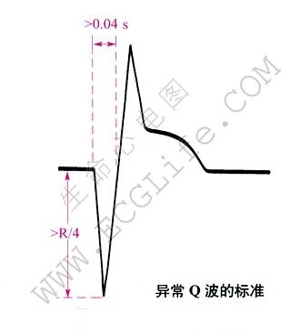 心肌梗死异常Q波的标准