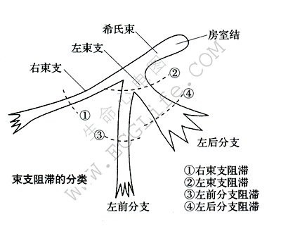 束支传导阻滞