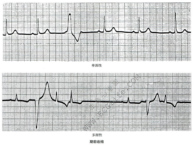 单源性、多源性期前收缩心电图