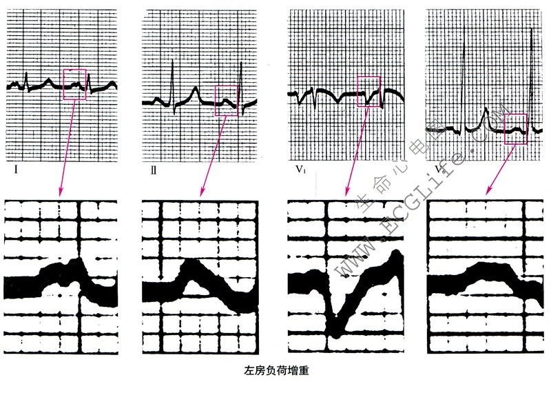 左房负荷增重
