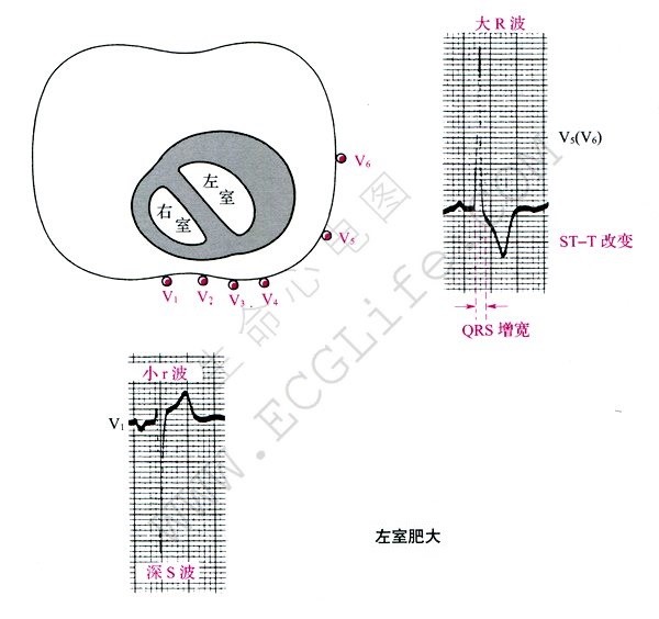 左心室肥大心电图表现