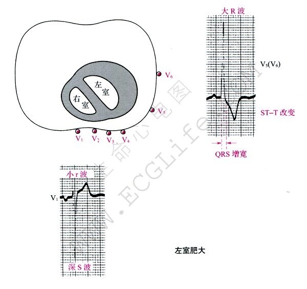 左心室肥大心电图