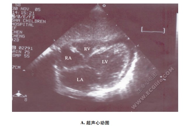 剑突下四腔心切面超声心动图