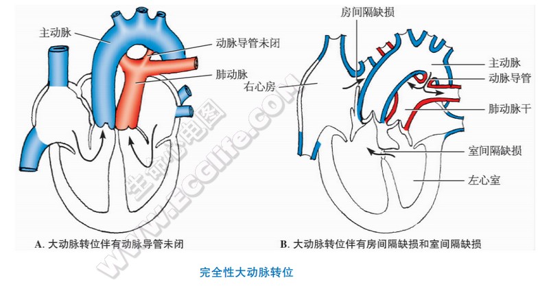 心脏完全性大动脉转位的先天性畸形