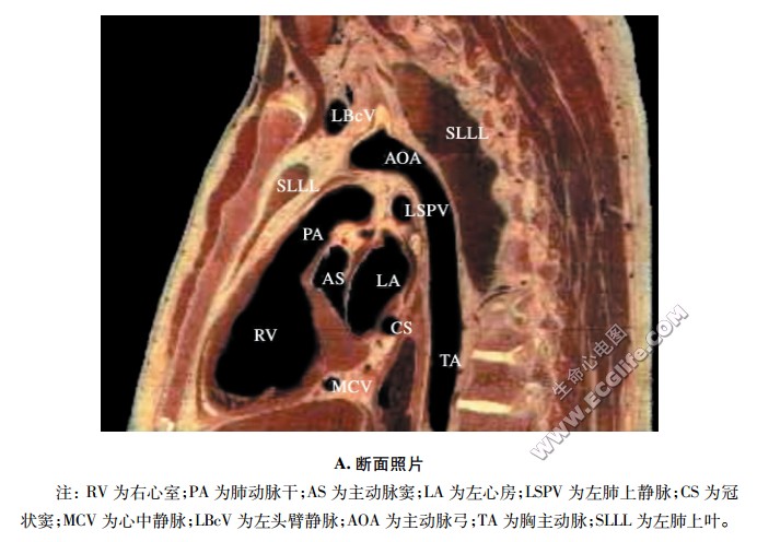 心脏左旁正中矢状断面