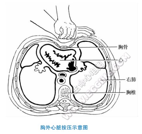 胸外心脏按压术操作示意图