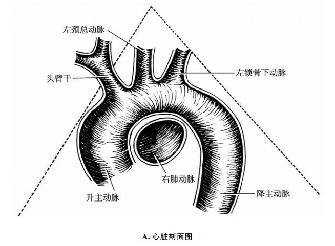 主动脉弓缩窄分型图片图片