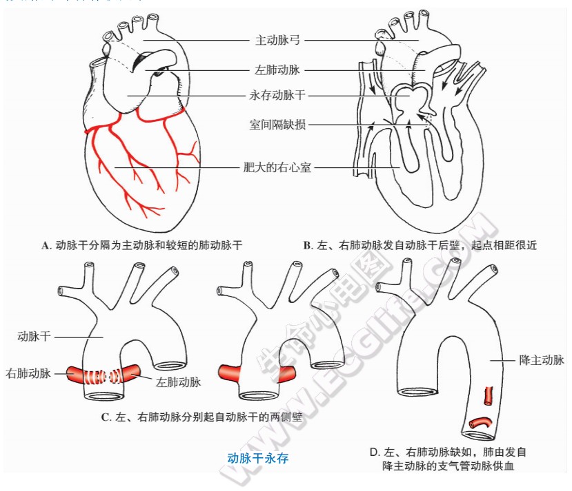 心脏动脉干永存