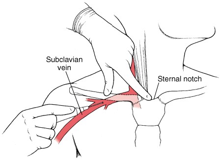 锁骨下静脉穿刺法