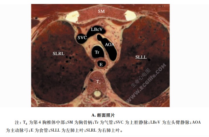 平第4胸椎体中部横断面解剖图