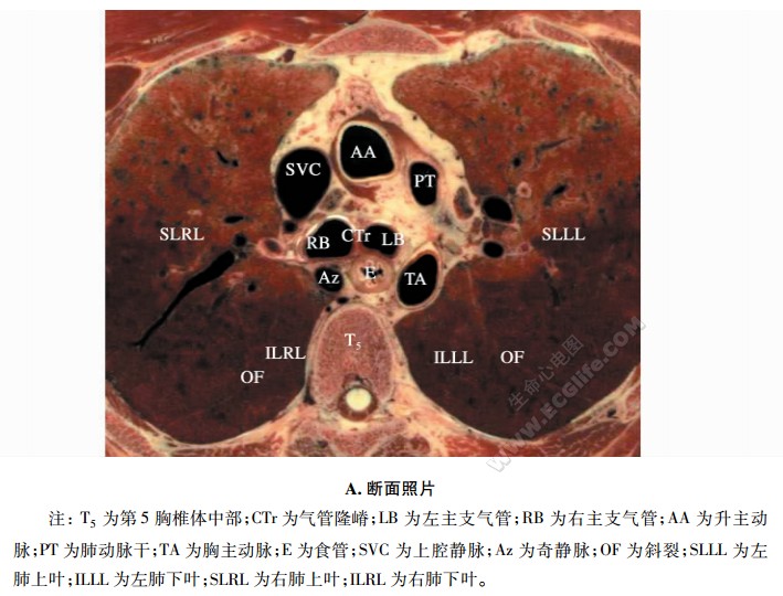 平第5胸椎体中部横断面解剖图