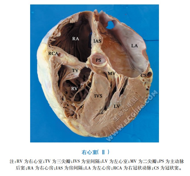 右心室腔内结构解剖图2