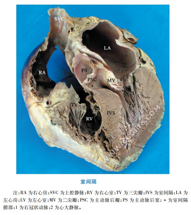 心脏室间隔解剖图