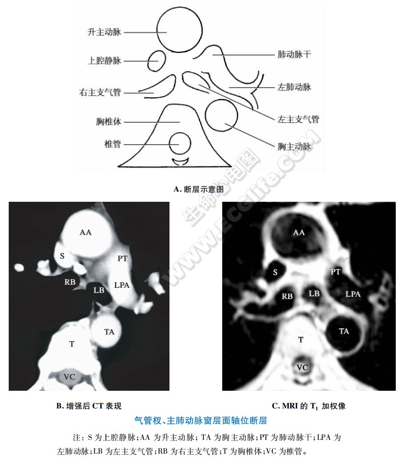 气管权、主肺动脉窗层面的CT和MRI断层解剖