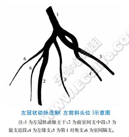 左冠状动脉造影（左前斜头位）示意图