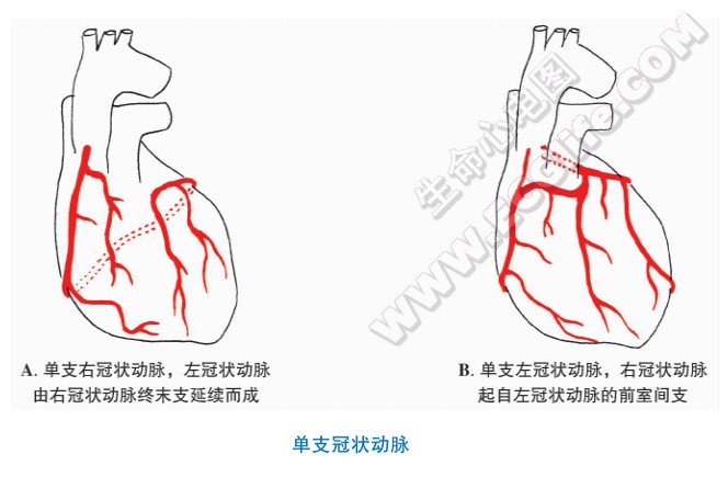 冠状动脉瘘