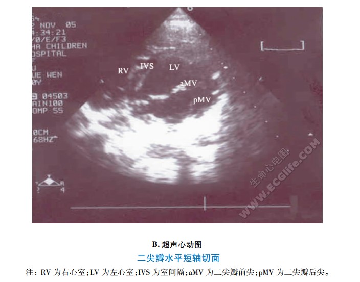 二尖瓣水平短轴切面、超声心动图
