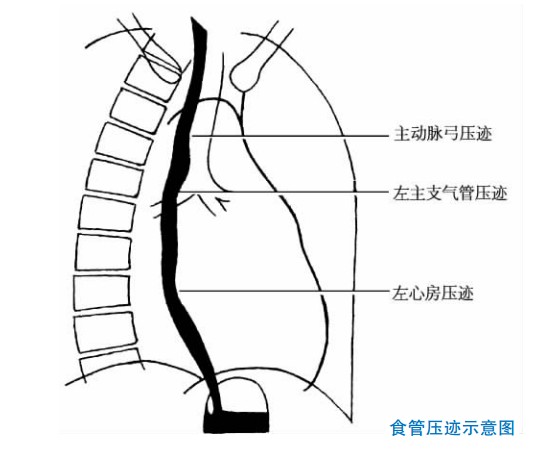 心脏食管压迹示意图