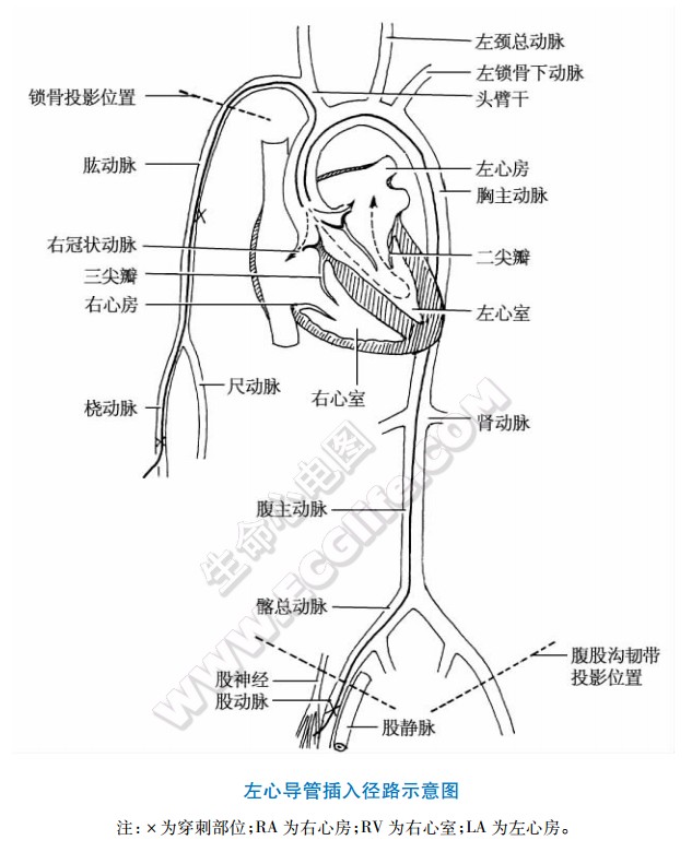 选择性冠状动脉造影