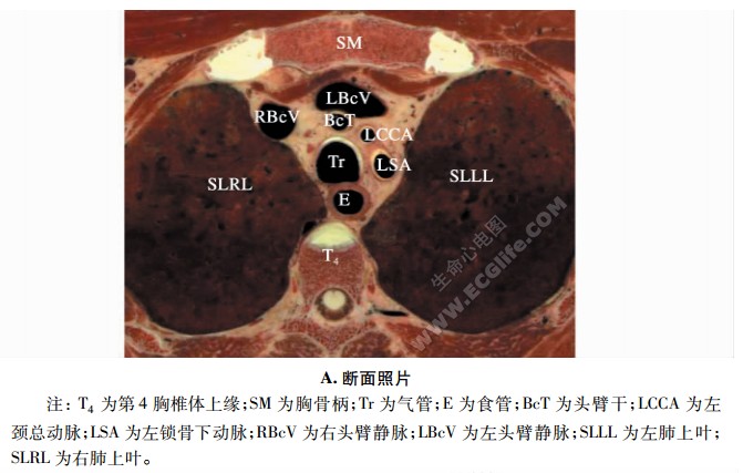 心脏横断面