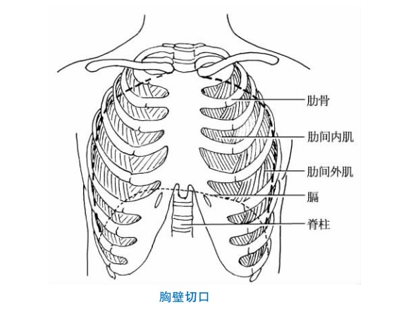 胸壁切口