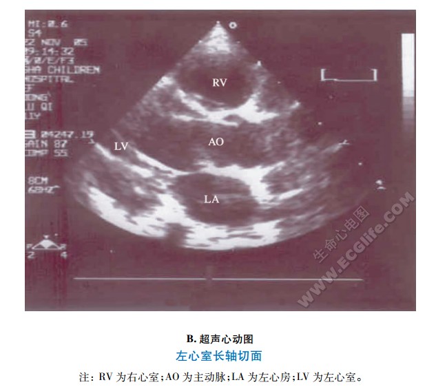 左心室长轴切面超声心动图
