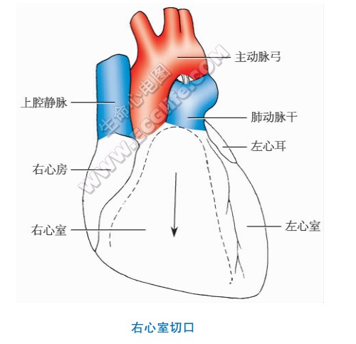 右心室解剖切口