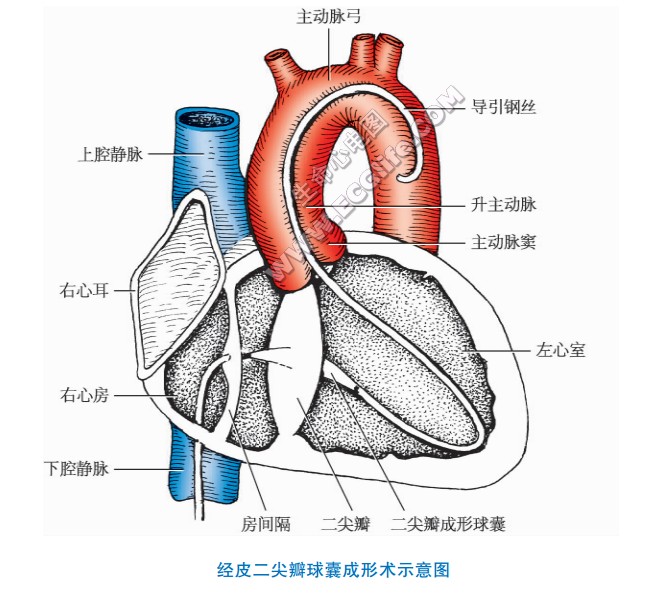 经皮瓣膜球囊成形术