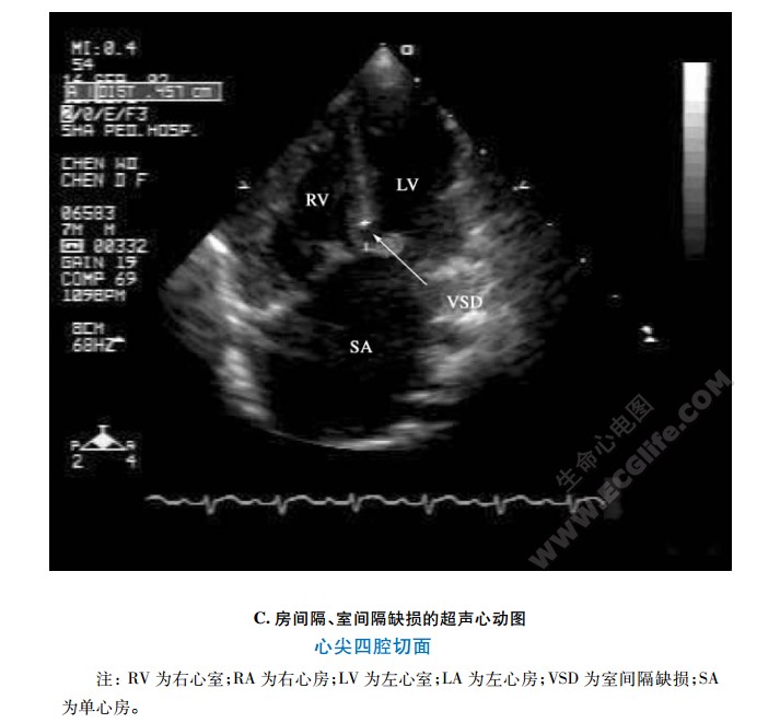 心尖四腔心切面、房间隔、室间隔映损的超声心动图