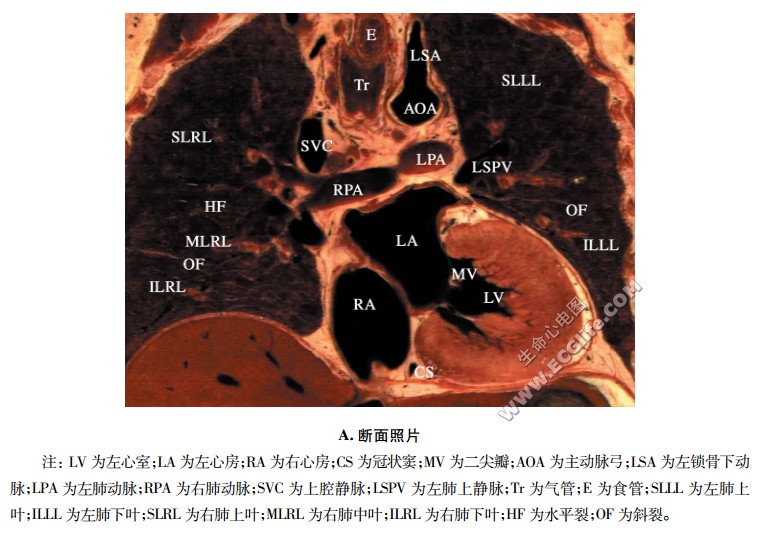 心脏经肺动脉权冠状断面解剖图