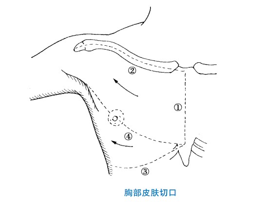 胸部皮肤切口