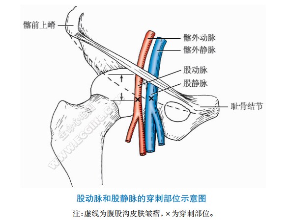 股静脉穿刺法