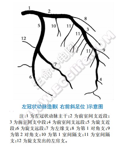 左冠状动脉造影（右前斜足位）示意图