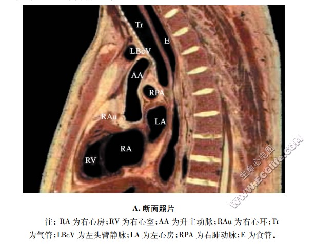 心脏正中矢状断面