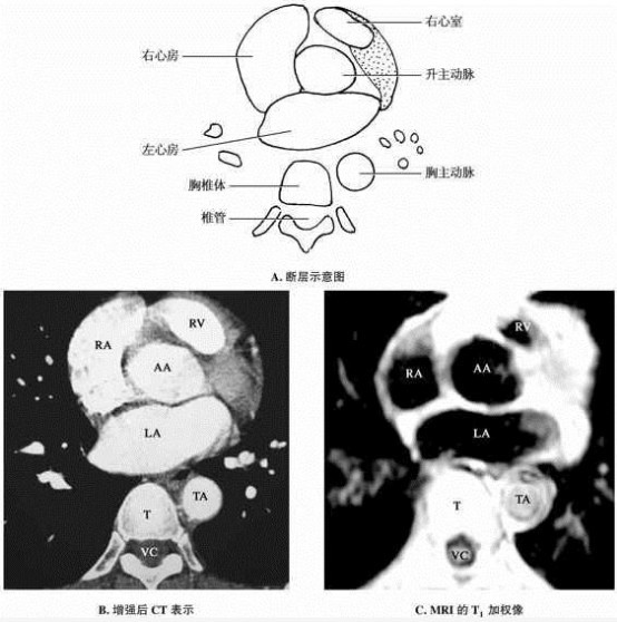 主动脉根部层面CT和MRI断层解剖