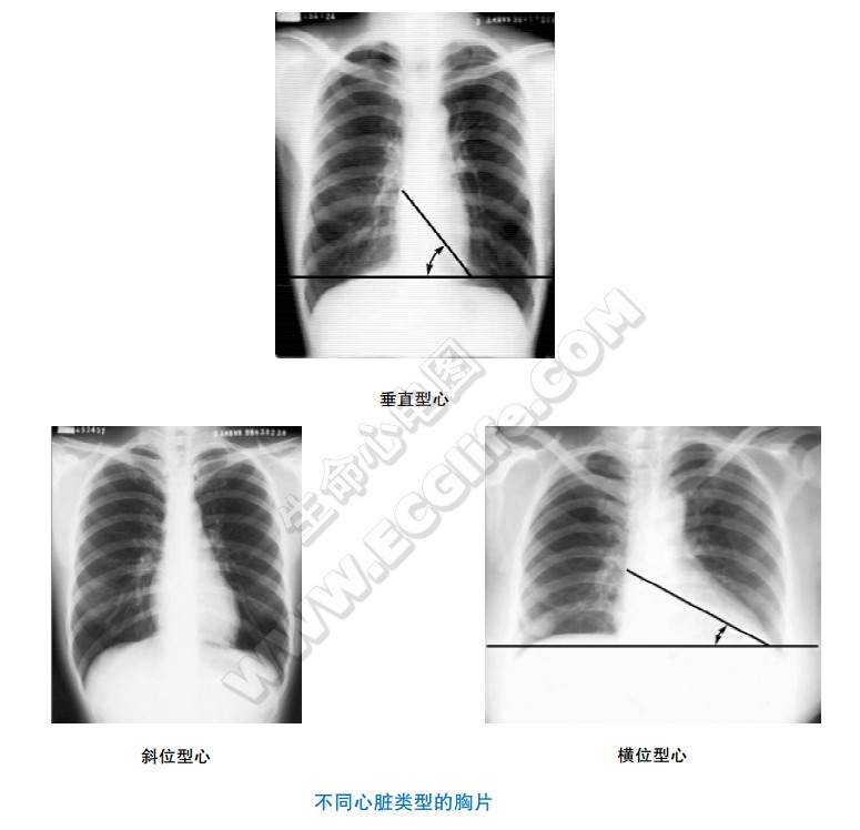 垂直型心、斜位型心、横位型心的胸片图