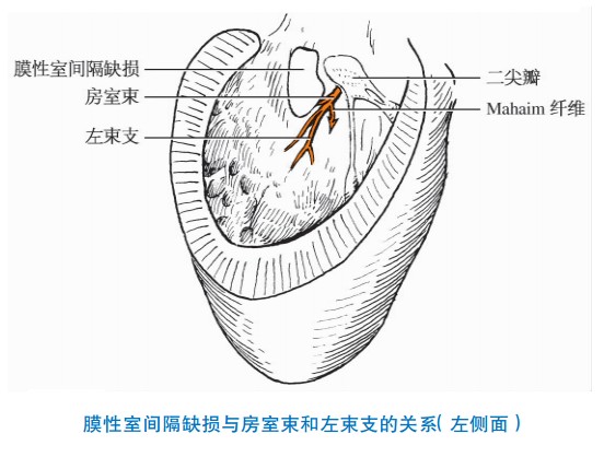 膜性室间隔缺损与房室束和左束支的关系（左侧面）