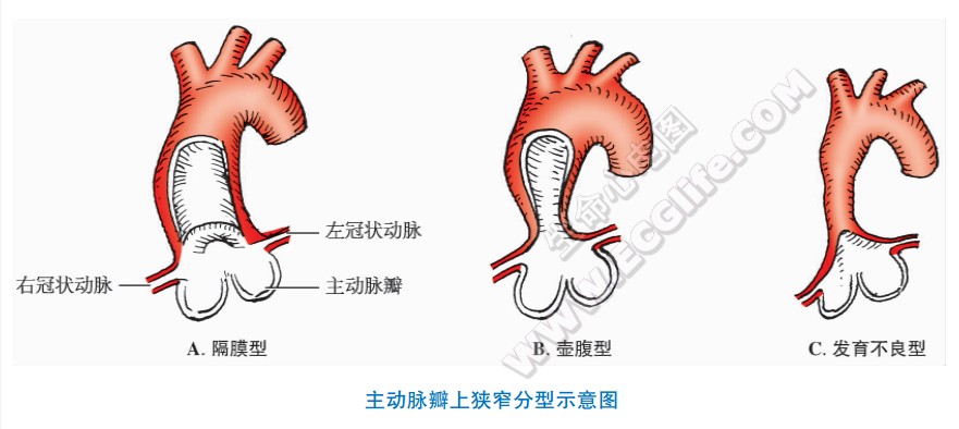 主动脉瓣上狭窄分型示意图