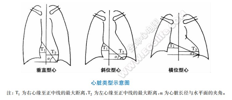 心脏心影类型示意图