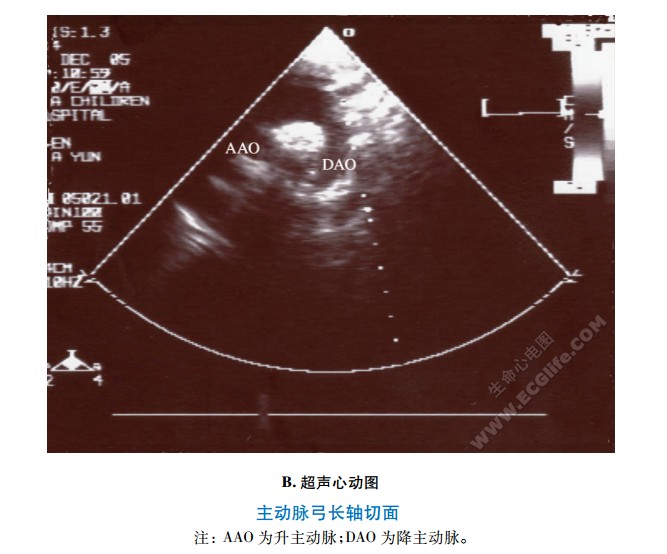 主动脉弓长轴切面超声心动图