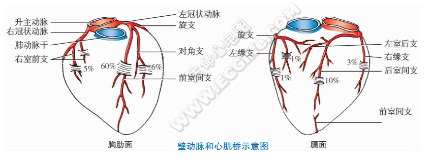 壁动脉和心肌桥示意图