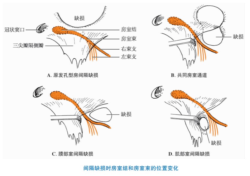 心传导系统畸形