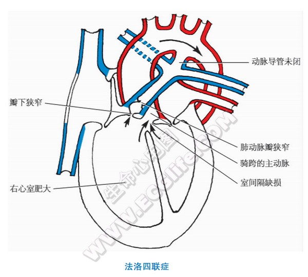 法洛四联症（先天性心脏畸形）